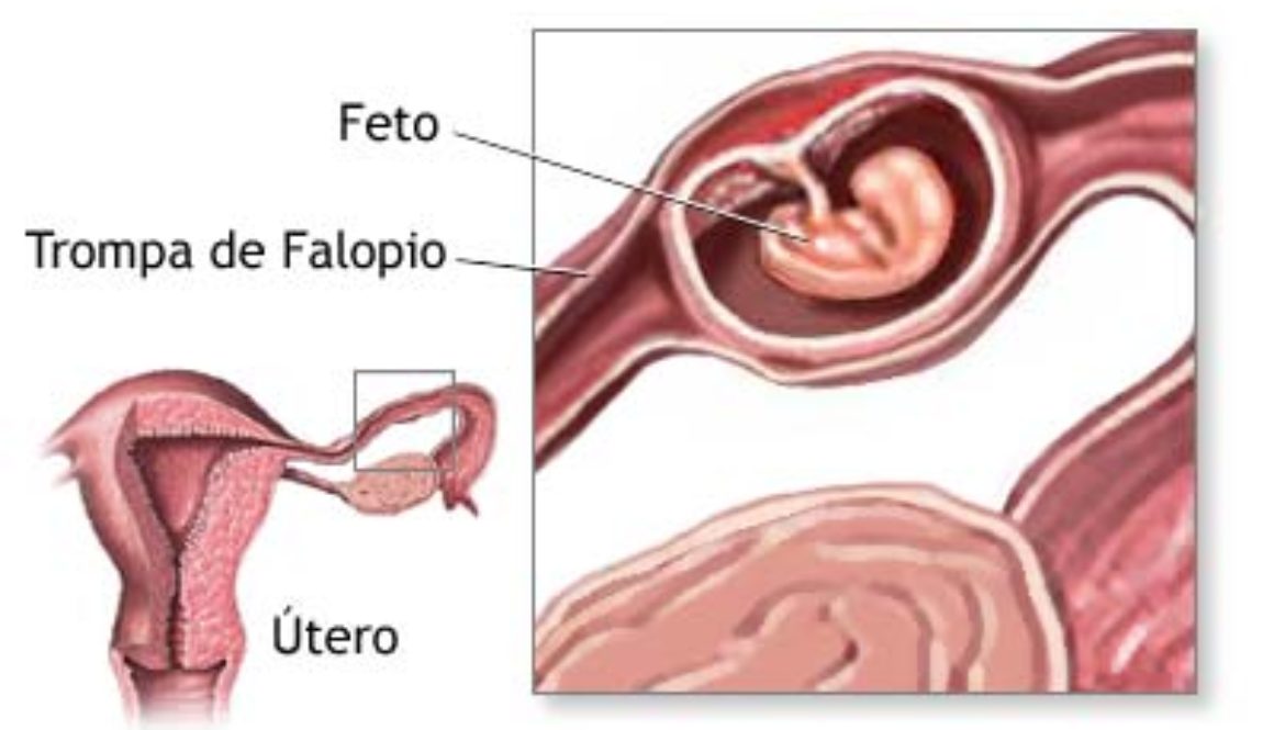 El embarazo ectópico