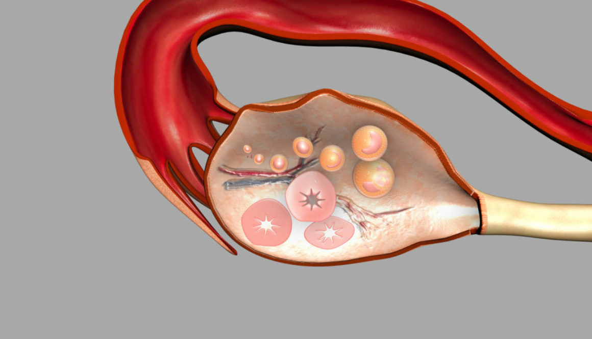 El ovario poliquístico